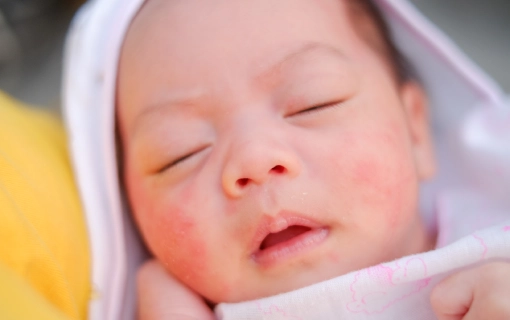 Bebeklerde Bağırsak Enfeksiyonu Belirtileri Nelerdir?
